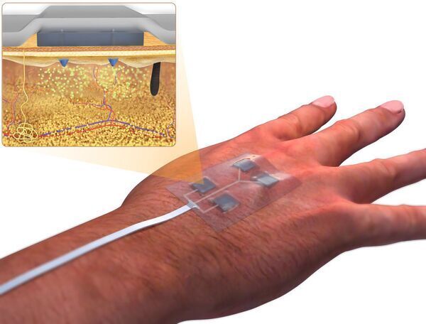 UConn Biomedical Engineer Creates “Smart” Bandages to Heal Chronic Wounds