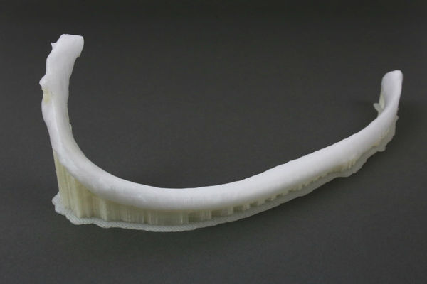 3D printed rib implanted in the human body