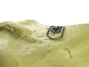 UArizona Researchers Develop Ultra-Thin 'Computer on the Bone'